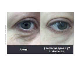 Resultado de antes e depois do tratamento com Laser Fotona Dynamis nas olheiras