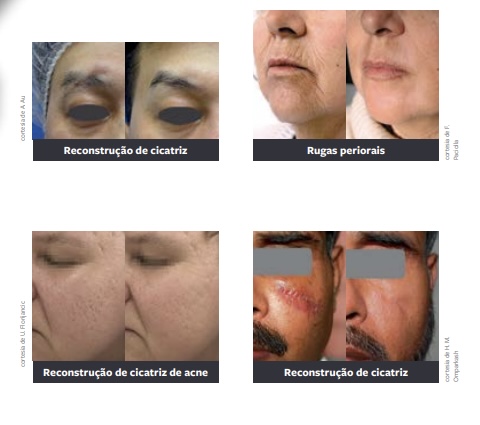 Resultado de antes e depois do tratamento com Laser Fotona Dynamis