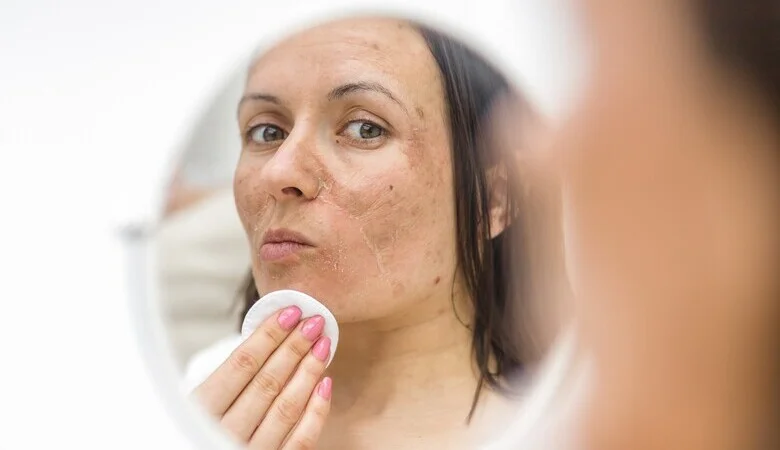 Melasma: Causas, Tratamentos e Como o Laser Pode Ajudar